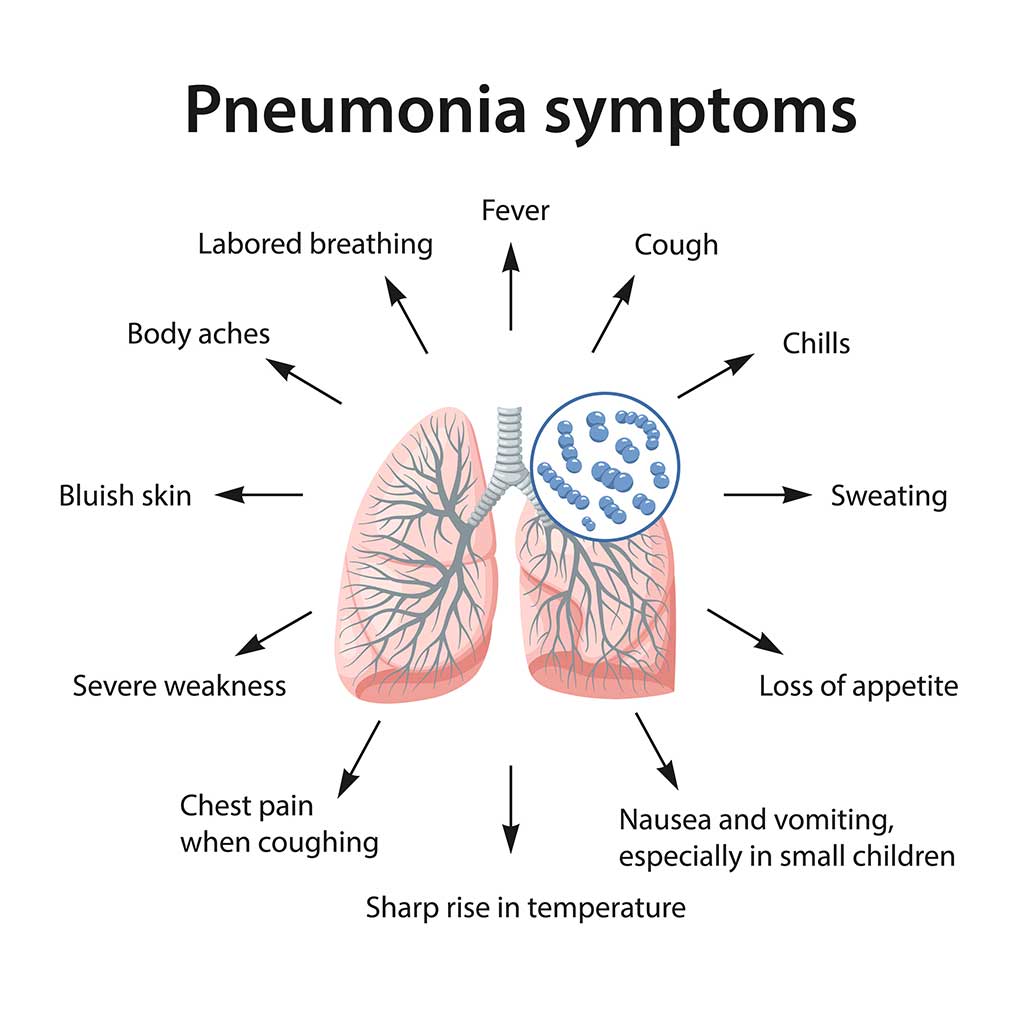 early sign of pneumonia